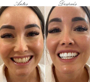 HISMILE CREMA DENTAL BLANQUEADORA✅